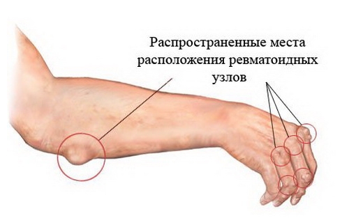 Расположение ревматоидных узлов Расположение ревматоидных узлов