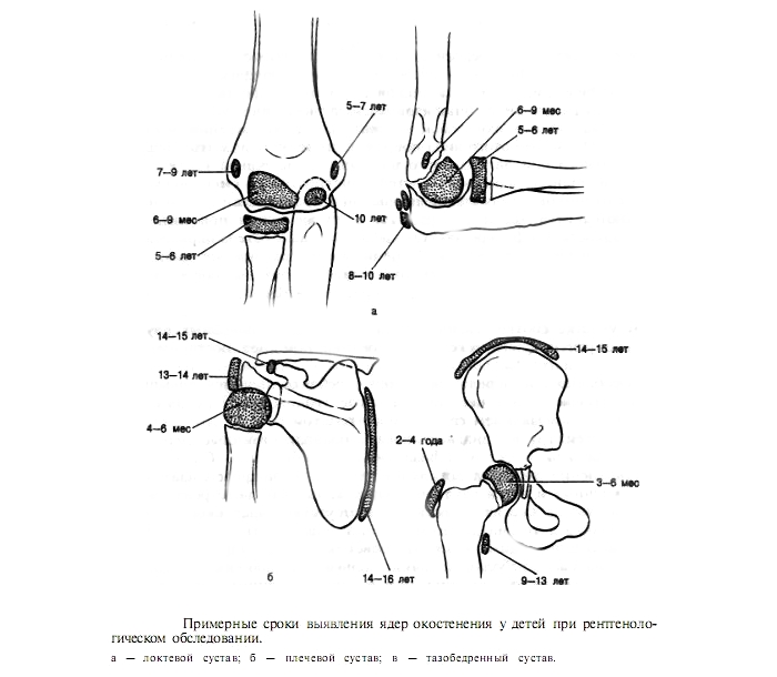 Распространение эпифизеолиза Распространение эпифизеолиза