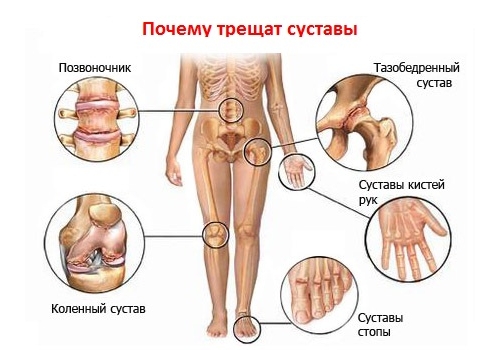 Распространение артроза Распространение артроза