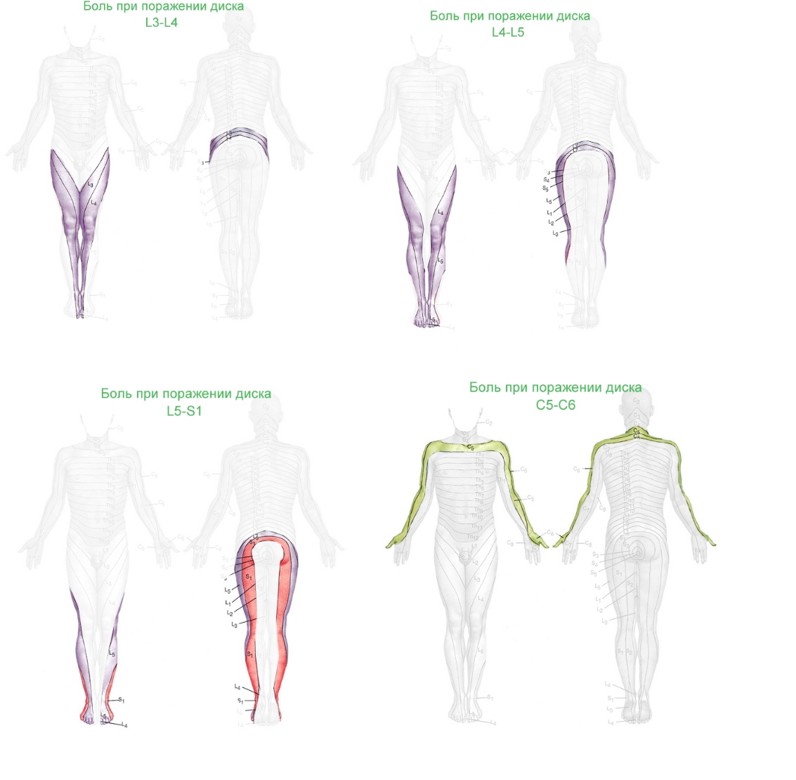 Распространение боли при протрузии и грыже различных позвонков Распространение боли при протрузии и грыже различных позвонков