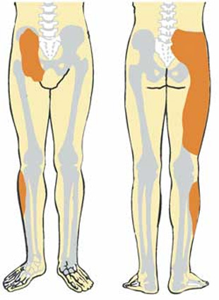 Распространение боли при сакроилеите Распространение боли при сакроилеите
