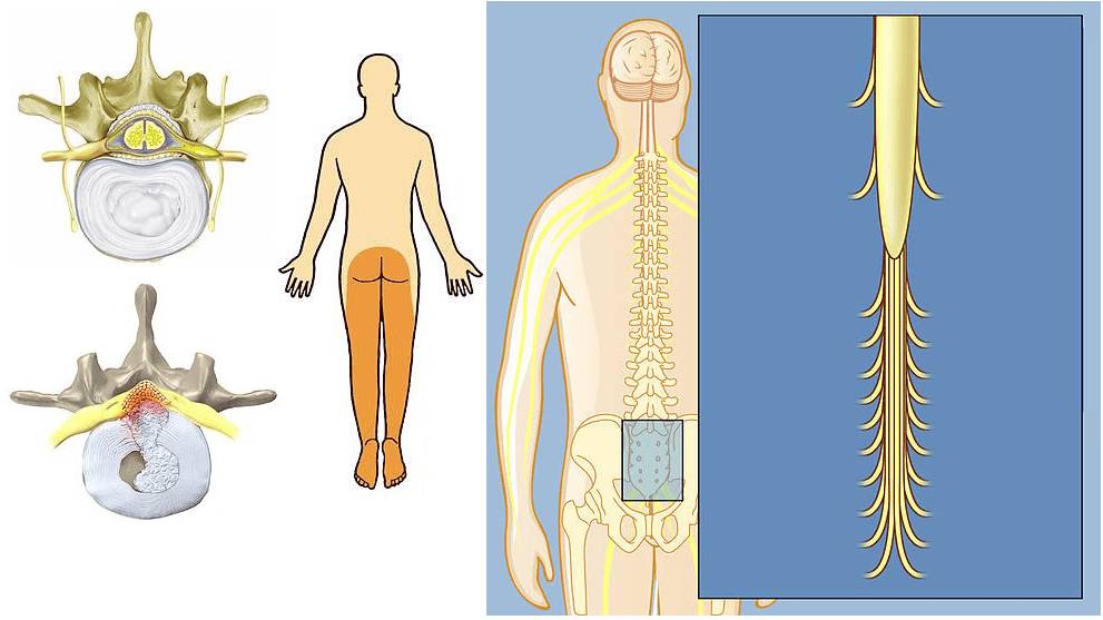 Распространение боли при синдроме конского хвоста Распространение боли при синдроме конского хвоста