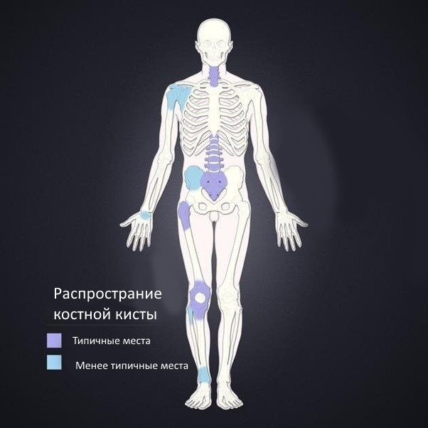 Типичные места распространения костной кисты Типичные места распространения костной кисты
