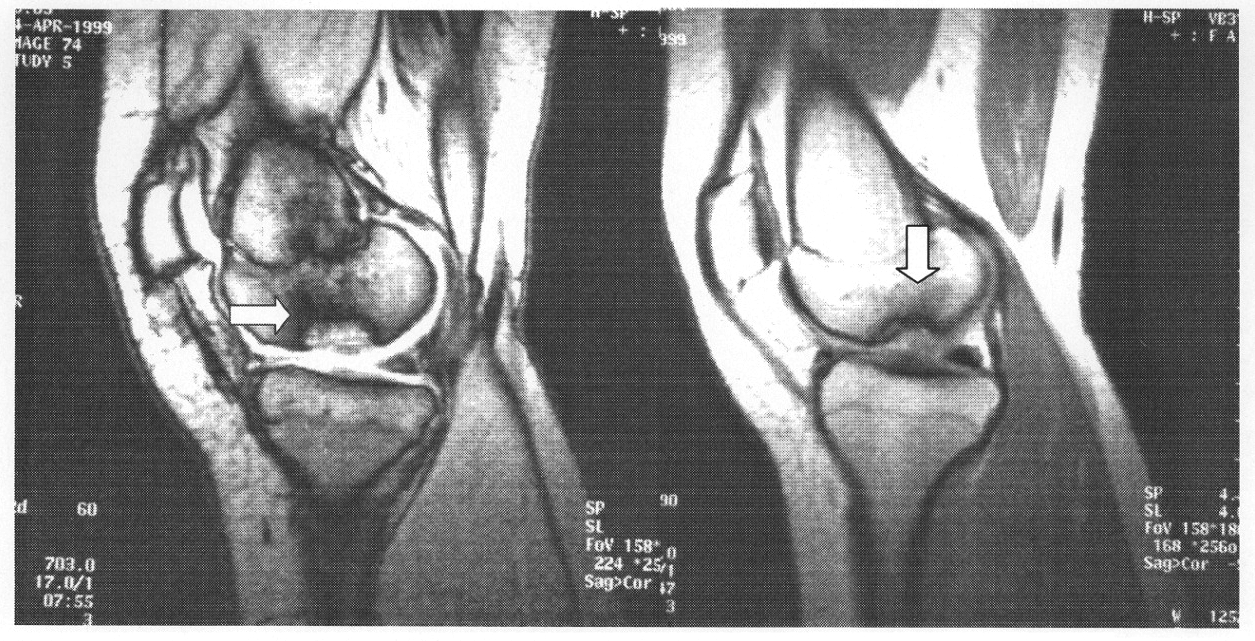Рассекающий остеохондрит на МРТ Рассекающий остеохондрит на МРТ