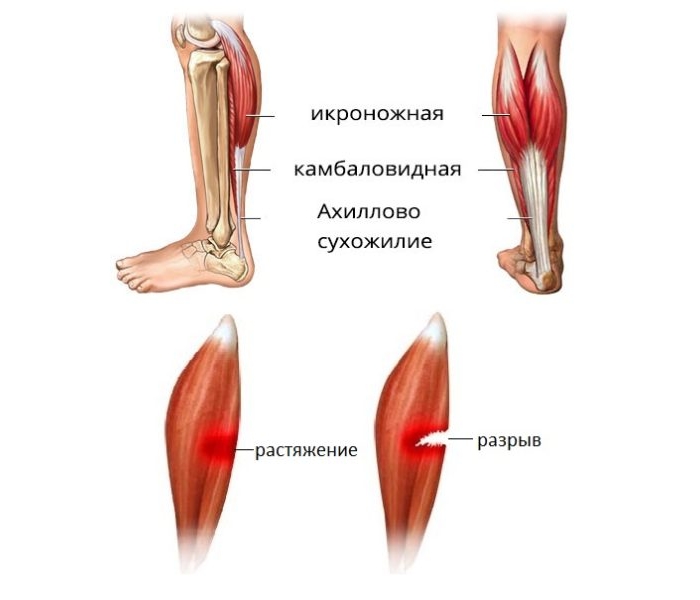 Растяжение и разрыв икр Растяжение и разрыв икр
