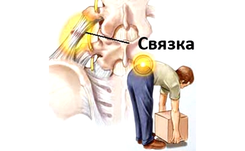 Растяжение мышц из-за поднятия тяжестей