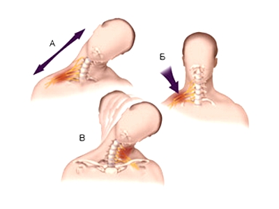Растяжение плечевого сплетения нервов Растяжение плечевого сплетения нервов