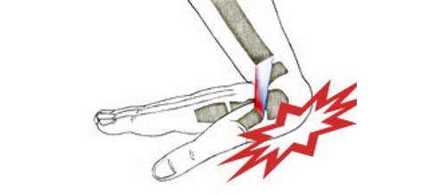 Растяжение связок запястья Растяжение связок запястья