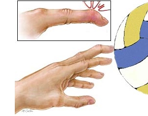 Травмирование пальца