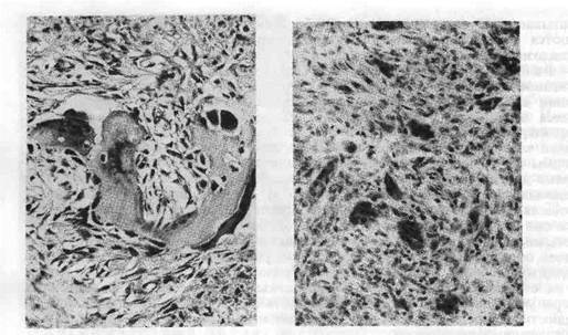 Разрастание опухоли Разрастание опухоли