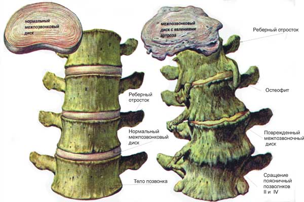 Сильное разрастание позвонков Сильное разрастание позвонков