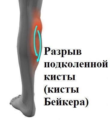 Отек голени при разрыве кисты Отек голени при разрыве кисты