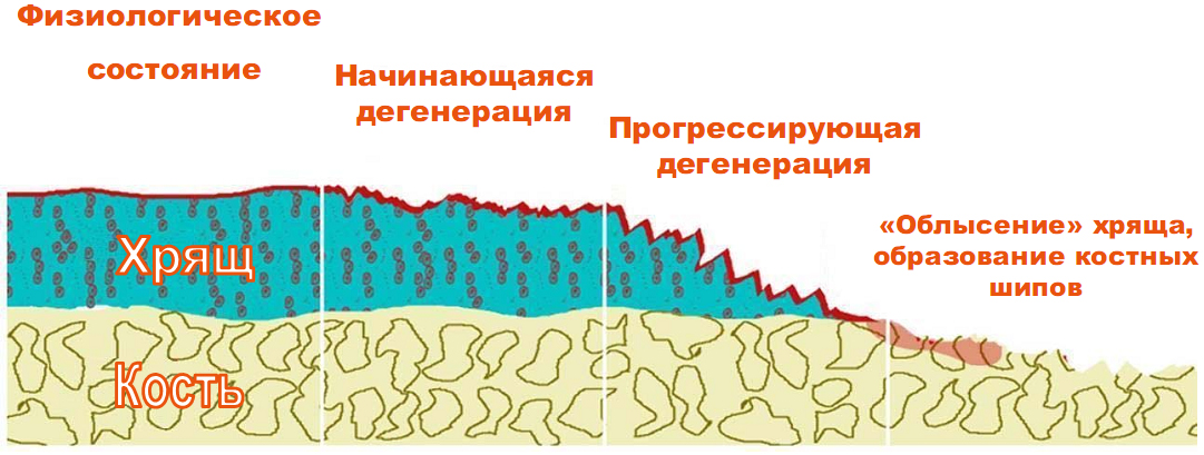 Разрушение хрящевой ткани при артрозе Разрушение хрящевой ткани при артрозе