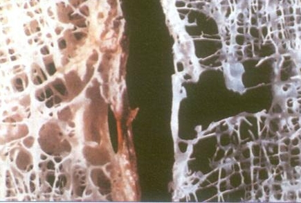 Разрушение костной ткани Разрушение костной ткани