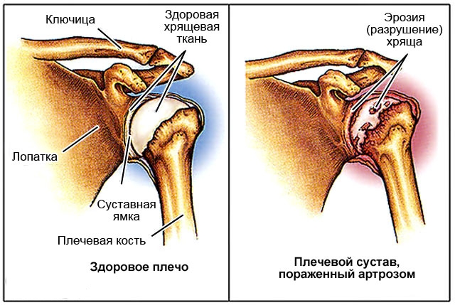 Разрушение плечевого сустава при артрозе Разрушение плечевого сустава при артрозе