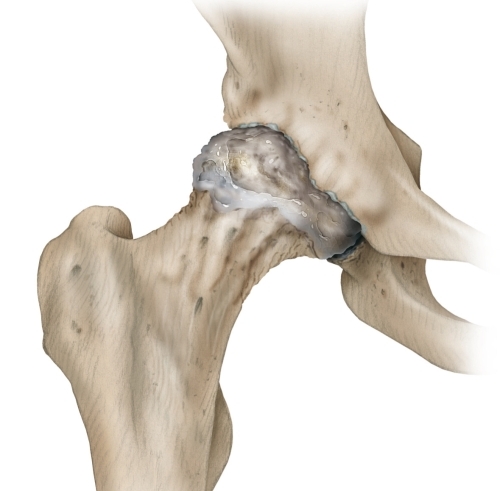 Разрушение тазобедренного сустава Разрушение тазобедренного сустава