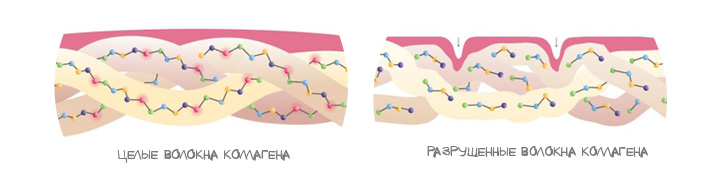 Разрушение волокн коллагена Разрушение волокн коллагена