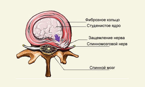 Разрыв фиброзного кольца Разрыв фиброзного кольца