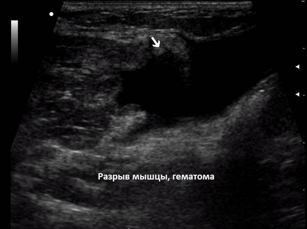 Разрыв мышцы бедра на УЗИ
