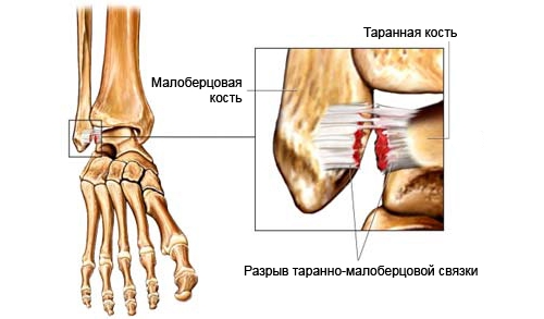 Разрыв связок лодыжки Разрыв связок лодыжки