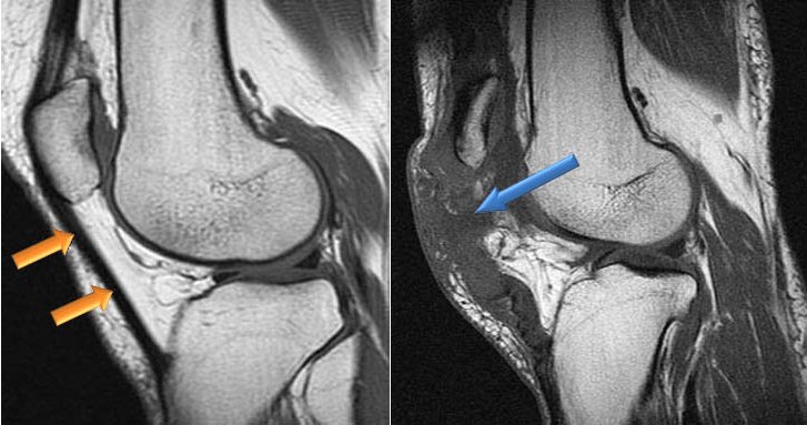 Разрыв связок колена на мрт Разрыв связок колена на мрт