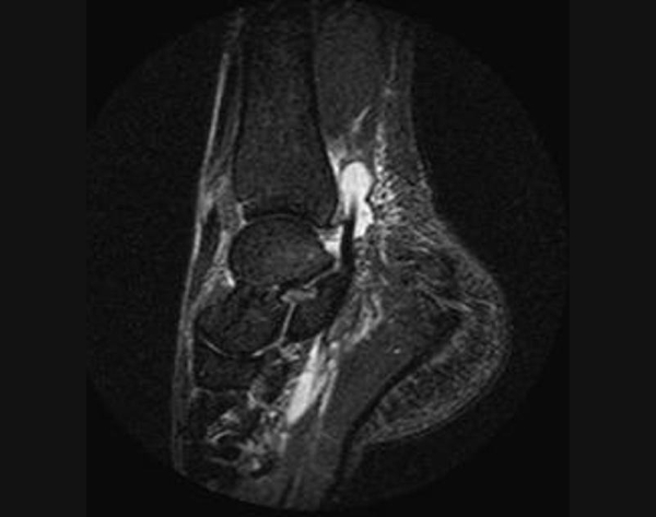 Разрыв талофибулярной связки голеностопа МРТ Разрыв талофибулярной связки голеностопа МРТ