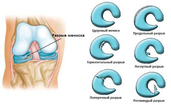 Разрывы мениска Разрывы мениска