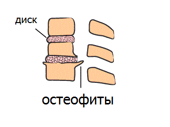 Разуршение дисков и костные остеофиты при шейном остеохондрозе Разуршение дисков и костные остеофиты при шейном остеохондрозе