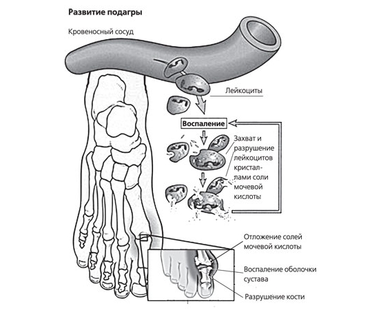 Развитие подагры Развитие подагры