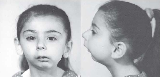 Ребенок больной анкилозом челюсти