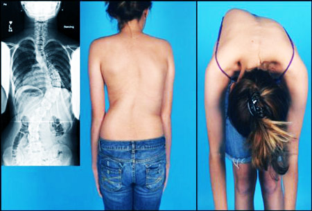 Внешний вид реберного горба Внешний вид реберного горба