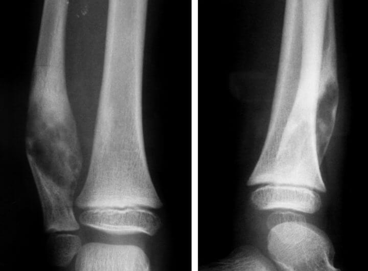 Рентген диагностика ложного сустава Рентген диагностика ложного сустава