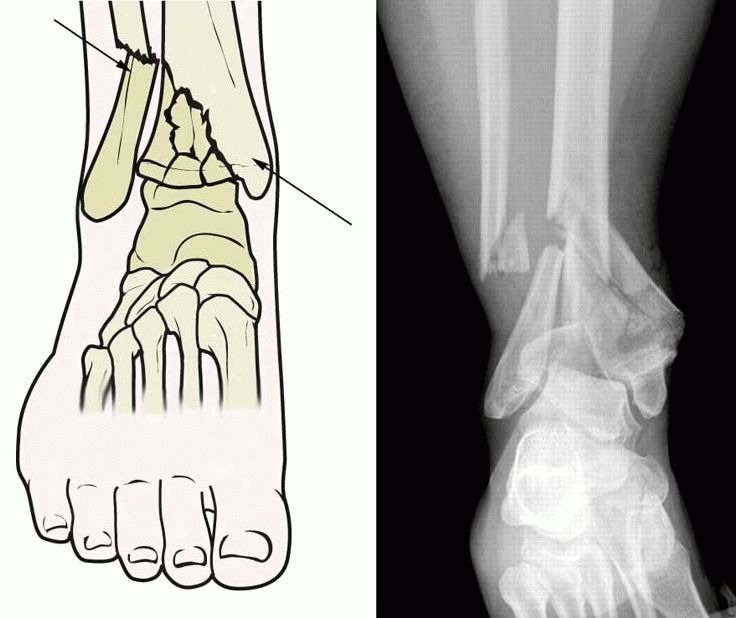 Рентгендиагностика перелома голени Рентгендиагностика перелома голени