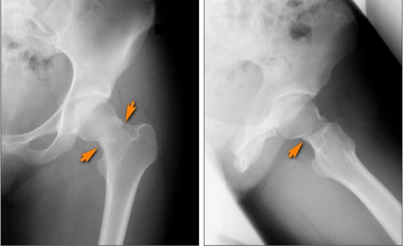 Рентген диагностика перелома шейки бедра Рентген диагностика перелома шейки бедра