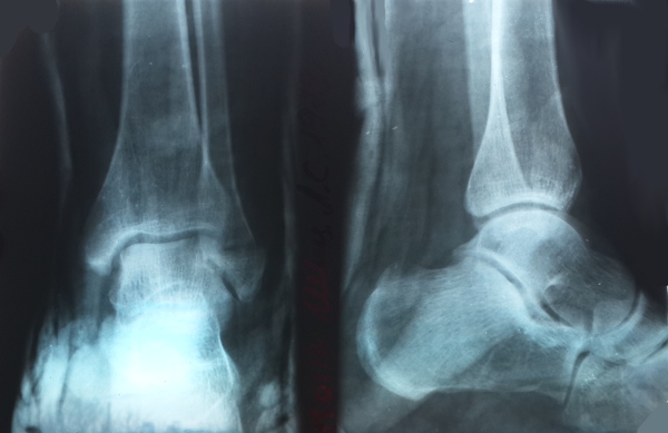 Рентген голеностопа в двух проекциях Рентген голеностопа в двух проекциях