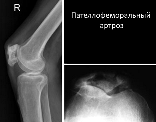Пателлофеморальный артроз на рентген снимке