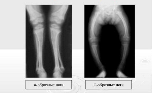 Рентгенография рахита Рентгенография рахита