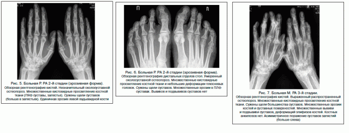 Рентгенологическая типология артрита по Штейнброкеру Рентгенологическая типология артрита по Штейнброкеру