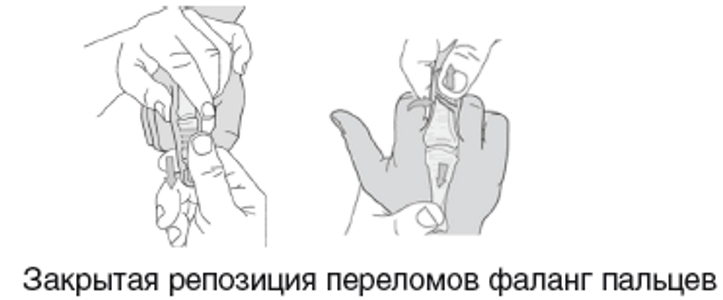 Закрытая репозиция пальца руки Закрытая репозиция пальца руки
