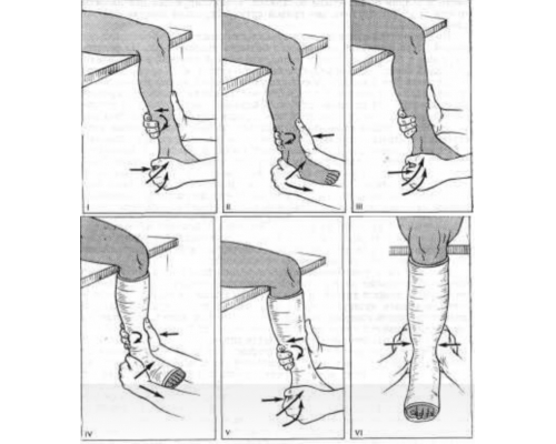 Репозиция при переломе лодыжки Репозиция при переломе лодыжки