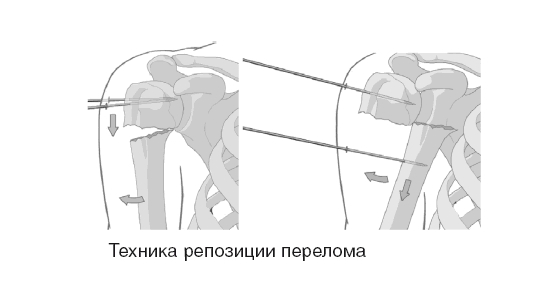 Репозиция при переломе плечевой кости Репозиция при переломе плечевой кости