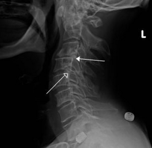МРт диагностика ретролистеза МРт диагностика ретролистеза