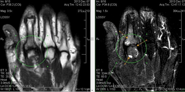 Ревматоидный артрит на МРТ Ревматоидный артрит на МРТ