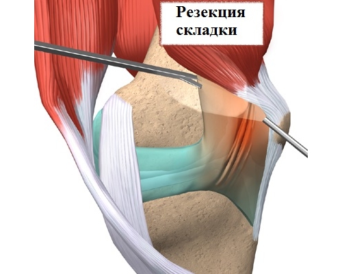 Резекция медиопателлярной складки Резекция медиопателлярной складки