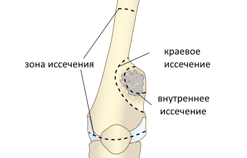 Резекция саркомы Резекция саркомы