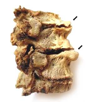 Рост остеофитов Рост остеофитов