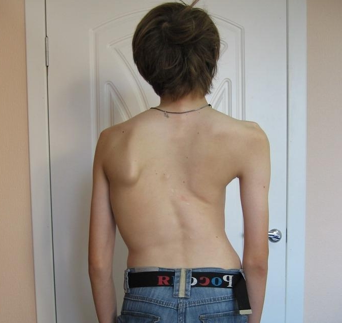 S-образный сколиоз фото