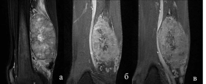 Саркома бедра на МРТ снимке Саркома бедра на МРТ снимке