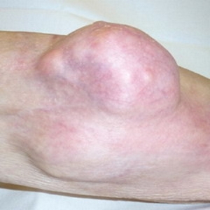 Растущая опухоль Растущая опухоль