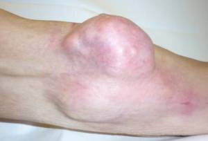 Саркома кости колена Саркома кости колена